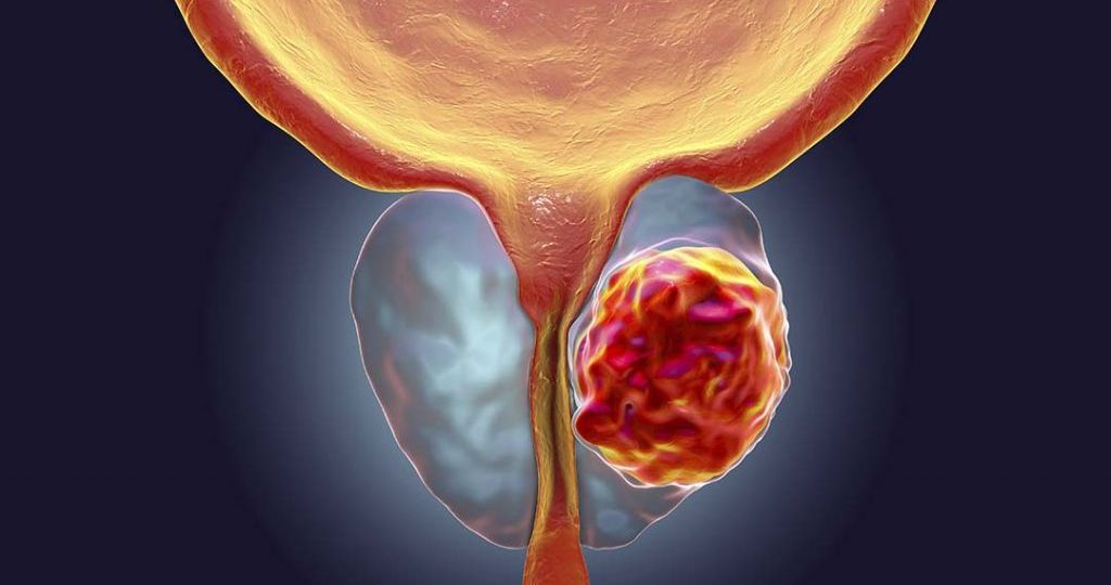 O-câncer-de-próstata-pode-voltar-após-a-cirurgia-1024x566
